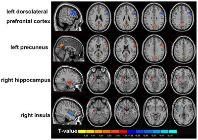 Aberrant resting-state regional activity in patients with postpartum depression